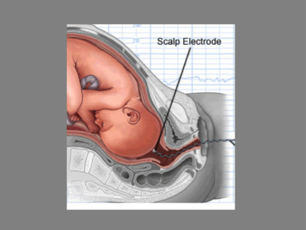 Please don't Screw my Fetal Scalp!! Indiegogo