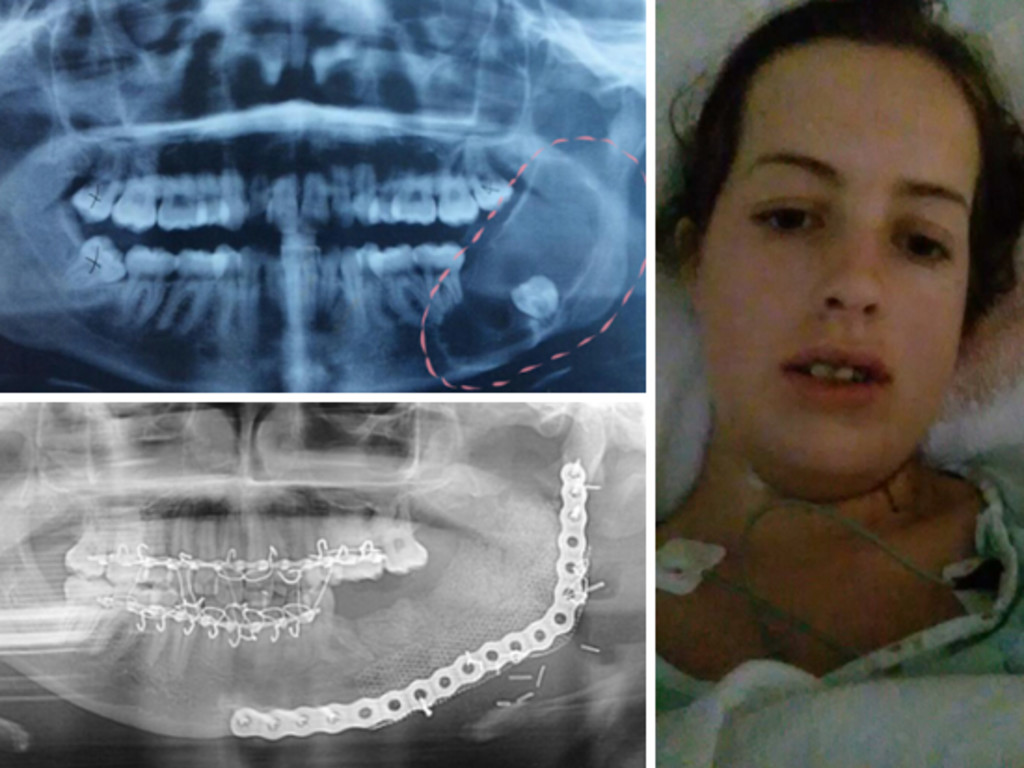 help-after-jaw-surgery-indiegogo