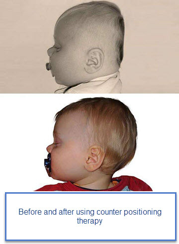 misshapen head in newborn